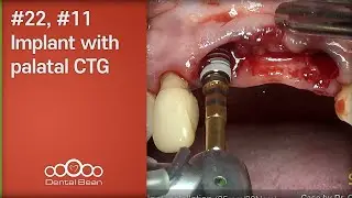 #22, #11 Implant with palatal CTG - [Dr. Cho Yongseok]