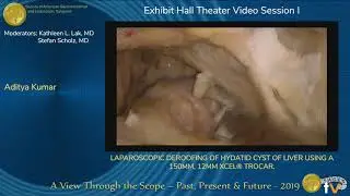 Laparoscopic Deroofing Of Hydatid Cyst Of Liver Using A 150mm, 12mm Xcel® Trocar