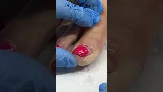 Reapproximating an avulsed toe nail