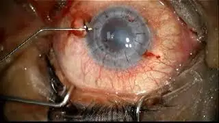 AIOC2018 - VT255 - DSEK After Failed Penetrating Graft
