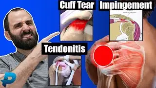 Shoulder Impingement vs Rotator Cuff Tendonitis vs Rotator Cuff Tear l Shoulder Pain