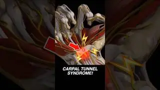 Doctor Explains: CARPAL TUNNEL SYNDROME! 🫴🏼💥