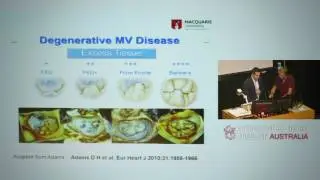 Assessment of the mitral valve through imaging - Dr Jason Kaplan