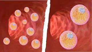 LDL particle size is a distraction | sdLDL vs particle number