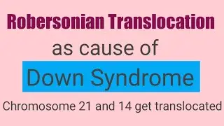 Robertsonian translocation as cause of Down syndrome.# downsyndrome,#robertsoniantranslocation.