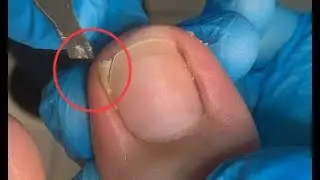 Large piece of nail removal