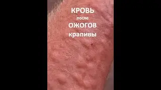 Кровь 🩸 после массажа крапивой