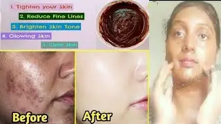 1 दिन में चेहरे के दाग धब्बे कैसे हटाए?Pigmentation को जड़ से ख़त्म करें | जिंदगी में दोबारा नहीं होगा