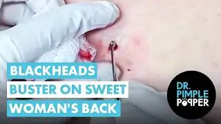 Blackhead Buster on Sweet Woman's Back