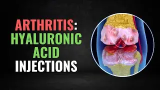 Unveiling the Truth about Hyaluronic Acid and Knee Arthritis