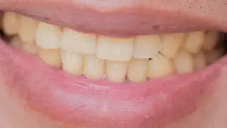 how to get rid of yellow stains on teeth naturally