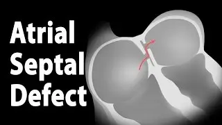 Atrial Septal Defect (ASD), Animation.