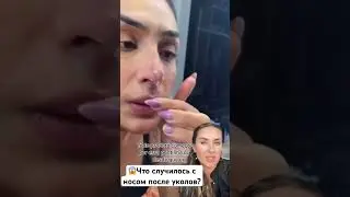 😱что с носом после уколов гиалуронки!Никогда не повторяйте это! 