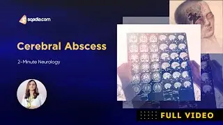 Cerebral Abscess Pathophysiology | 2-Minute Neurology Video | V-Learning™