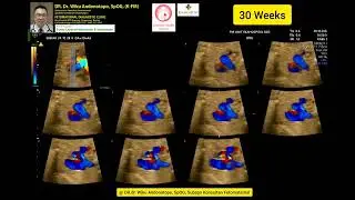 Trimester III Screening and Fetal Echocardio