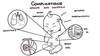 What is Pertussis and whooping cough? - Bordetella pertussis symptoms, pathophysiology and treatment