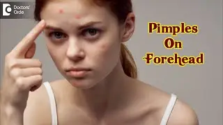 Pimples On Your Forehead? Causes & how to get rid of it? - Dr. Urmila Nischal  | Doctors'Circle