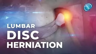 What is Lumbar Disc Herniation? | Herniated Disc