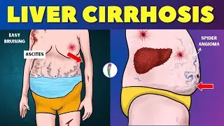 Liver cirrhosis - Warning Signs 🔥 Don't ignore these Red Flags | Chronic Liver Disease | Fatty Liver