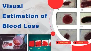 Visual Estimation of Blood Loss