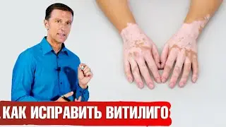 Лечение витилиго. 3 натуральных средства от витилиго.