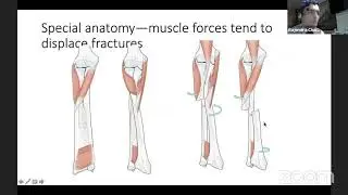 Forearm Plating & Dealing with Monteggia & Galeazzi by Dr RM Chandak