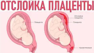 ОТСЛОЙКА ПЛАЦЕНТЫ ПРИ БЕРЕМЕННОСТИ Экстренное состояние беременных Как распознать отслойку плаценты