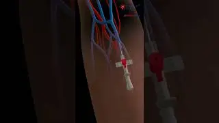 IV Insertion 💉 IntraVenous Catheter ⚕️ 3D Medical Animation Ep.1