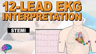 Recognize ST Elevation Myocardial Infarction (STEMI) on 12-lead EKG!