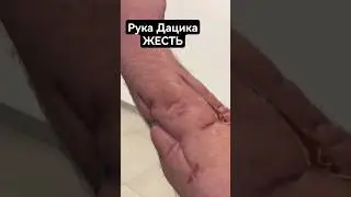 Дацик показал травмированную руку: ЖЕСТЬ 