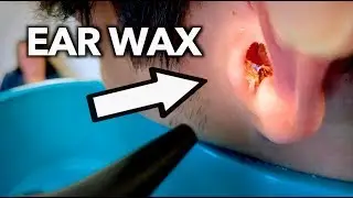 JUICY EAR WAX REMOVAL | Dr  Paul