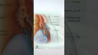 Minimally invasive glaucoma surgery (MIGS) #shorts