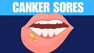 What is CANKER SORES? Causes, Signs and Symptoms, Diagnosis and Treatment