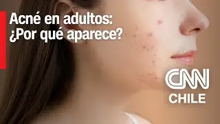 El acné en personas adultas: ¿Por qué aparece y con qué tratamientos se puede combatir?