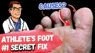 BEST Athletes Foot Fungus Treatments [HOME Remedies + 3 BIG SECRETS]