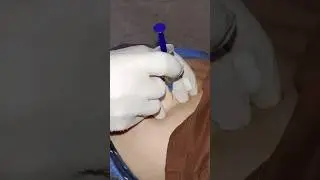 ازاي تعطي حقنة عضل لطفل عصبي How do you give an intramuscular injection to a relax child