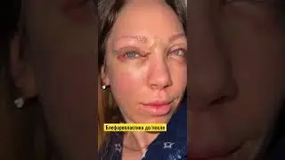 блефаропластика, результат в конце 