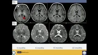 Neuroimaging of Pediatric Disease