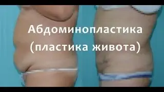 Абдоминопластика (пластика живота) 18+ ВИДЕО  ОПЕРАЦИИ