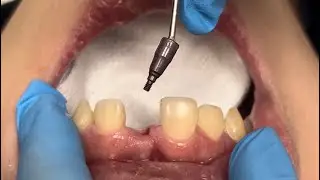 Dental Implants , Bone Graft