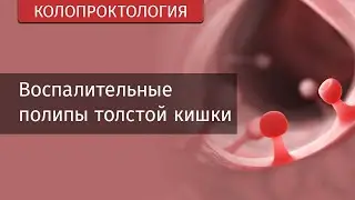 ДЕМО Воспалительные полипы толстой кишки | Лекции по патологической анатомии