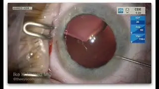 Severe Microspherophakia Dislocated Lens