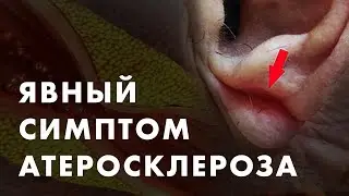 АТЕРОСКЛЕРОЗ И МОЧКА УХА. БЕЗОБИДНЫЙ ДЕФЕКТ ИЛИ ИЛИ СЕРЬЕЗНЫЙ СИМПТОМ? | Клиника Online