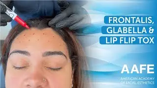 Frontalis, Glabella & Lip Flip Tox