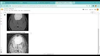 Brain Tumor Detection using Machine Learning