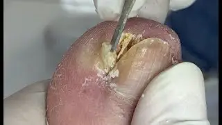 Professional nail cuticle cleaning