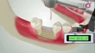 Dio Implant Dental Implant Education Video for Dentist