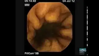 The PillCam Detection of Meckel's Diverticulum