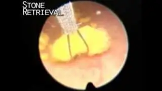 Canine: Laparoscopic-assisted bladder stone removal (Dr. Jeffrey Runge DACVS)