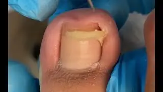 Big “Cave” under nail